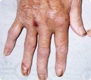 Artritis psoriásica