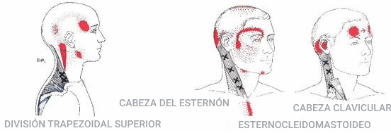 Preguntas frecuentes sobre el síndrome cervical