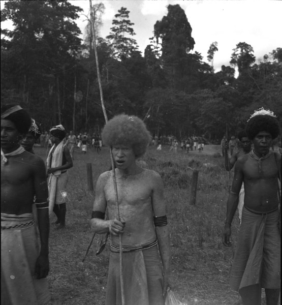 Dobodura Natives, Albino Man