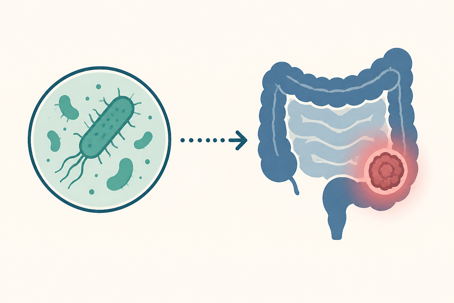 New study finds link between common stomach bug exposure and bowel cancer