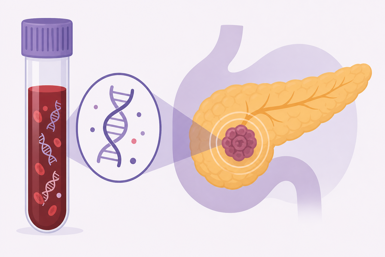Liquid biopsy for early detection of pancreatic ductal adenocarcinoma