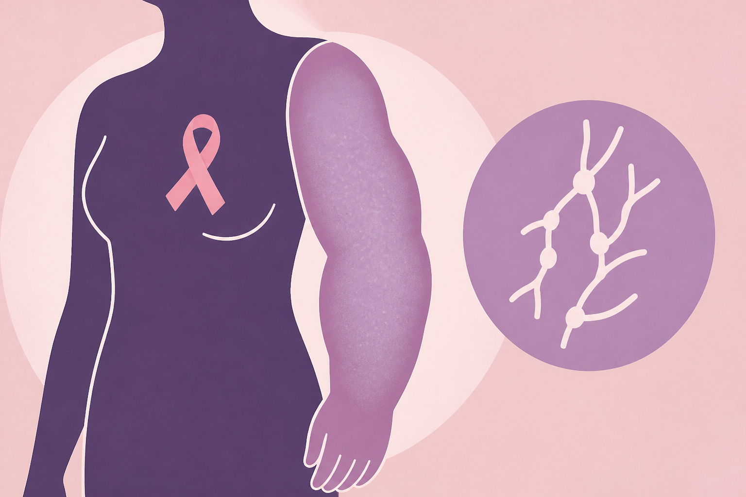 Many people develop painful swelling after breast cancer treatment. What to know about lymphedema