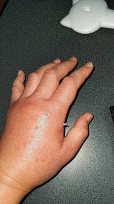 蜂に刺されたことのある方におたずねします