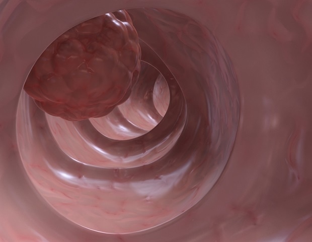 High cannabis use associated with increased colon cancer mortality