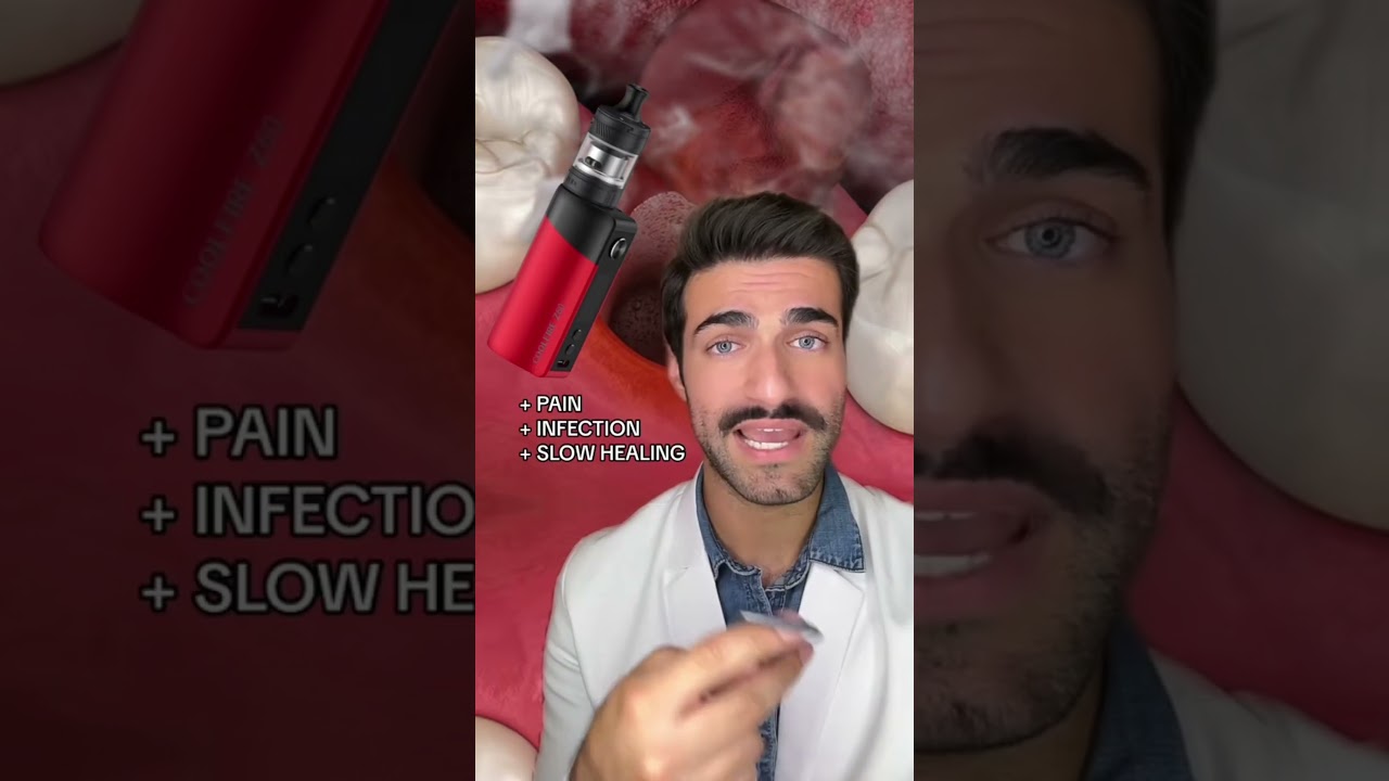 Wisdom Teeth - Vaping & Dry Sockets?! #shorts