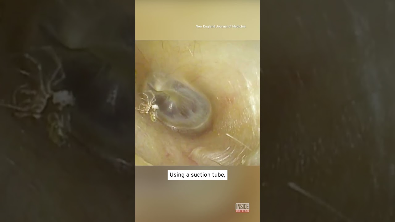 Spider Lives in Woman’s Ear Canal for 4 Days #shorts