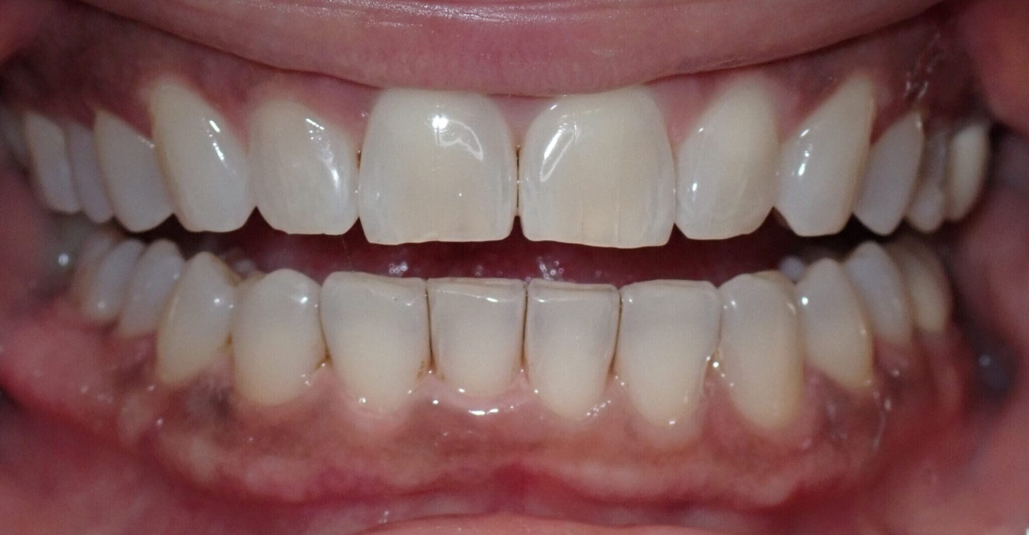After clear aligner treatment at Redmond Signature Dentistry