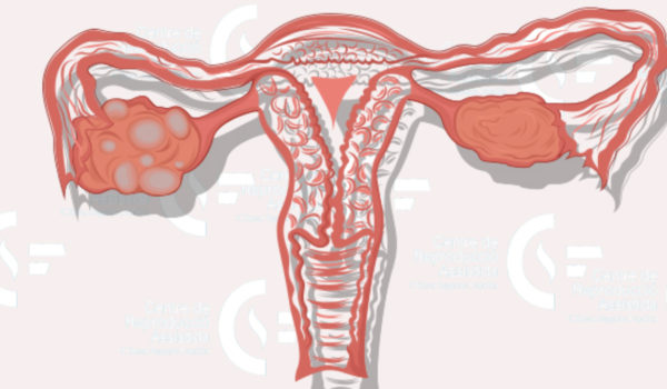 Síndrome de ovarios poliquísticos