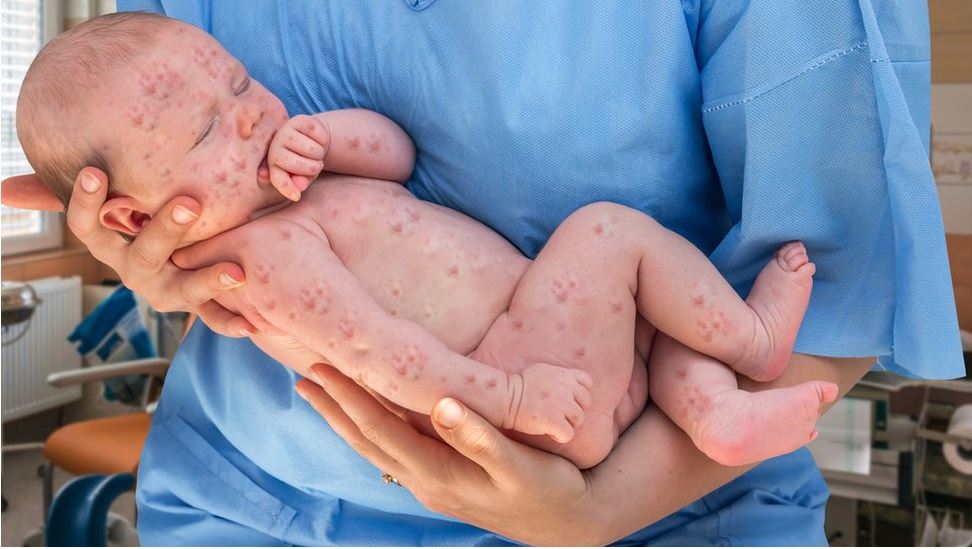 Sarampión: 8 mitos sobre las vacunas que pueden explicar los nuevos brotes de una enfermedad fácilmente evitable