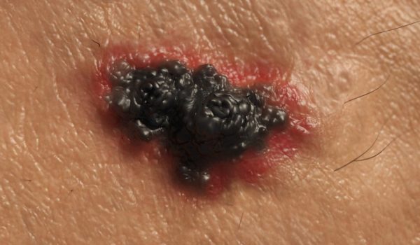 Cáncer de piel: el tratamiento que permite que el 52% de pacientes con melanoma avanzado sobreviva al menos 5 años