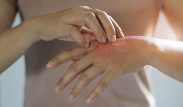 Qué es la psoriasis y por qué puede causar problemas en el corazón