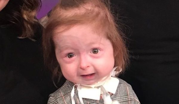 La niña de 2 años con una condición única que acelera su envejecimiento