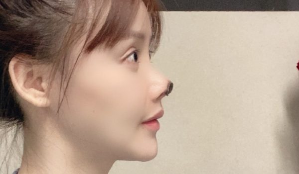 Las fotos de «la pesadilla» que fue la operación de nariz de la estrella de cine china Gao Liu