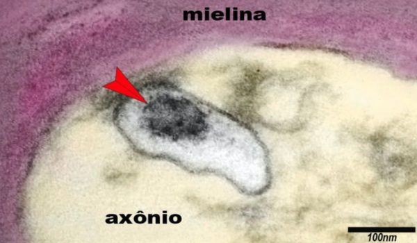 Coronavirus: autopsias revelan por qué es tan difícil diagnosticar covid-19 en niños