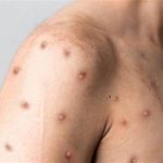 La OMS declara la viruela del mono emergencia de salud pública internacional