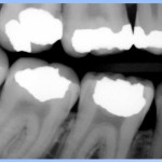 Quickray Sensor Bitewing