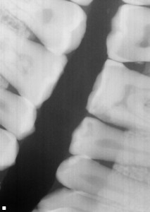 Schick TM Size 2 Bitewing Image