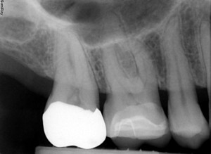 SuniRay2 BiteWing From Suni Website