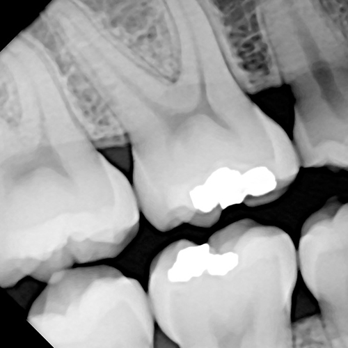 UniRay Size 1.5 Digital X-Ray Sensor - Image 4