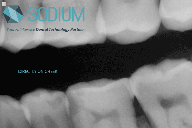 Repaired Schick Xray Sensor Distance Progression