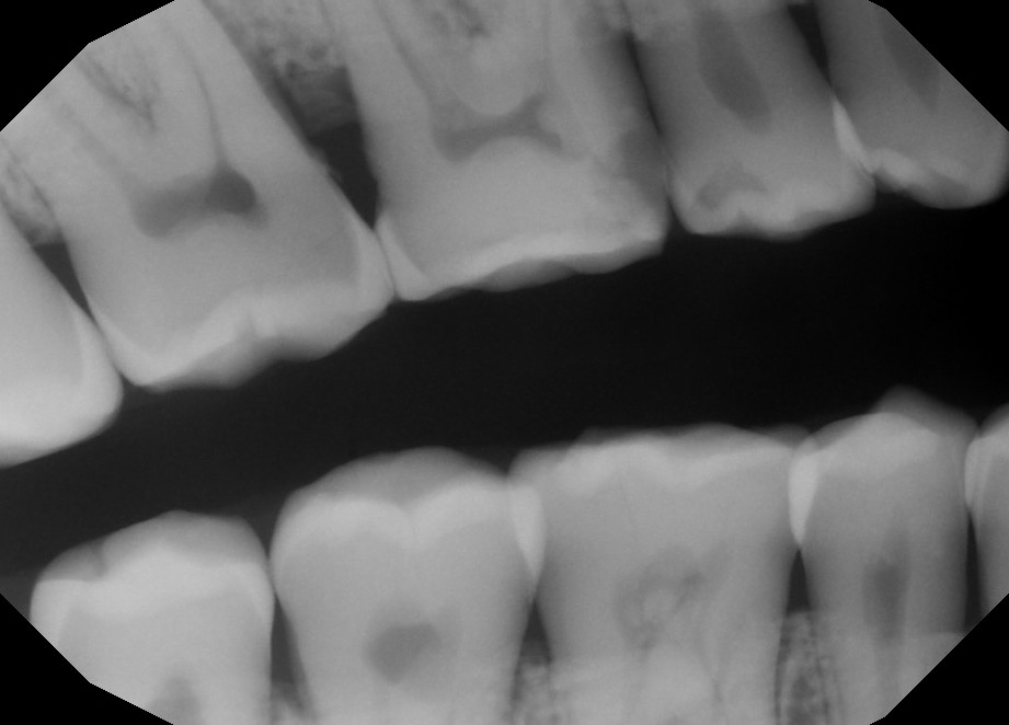 Pre-Owned Kavo IXS size 2 SN: 15007009 - Image 2