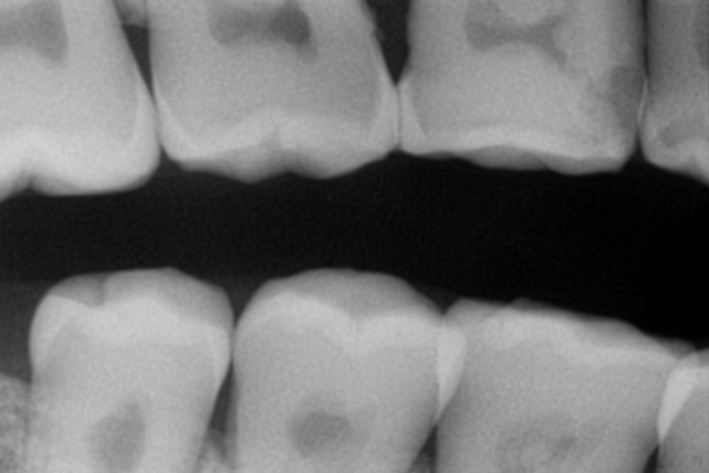 Pre-Owned Schick Elite Size 1 SN 11004443 - Image 11