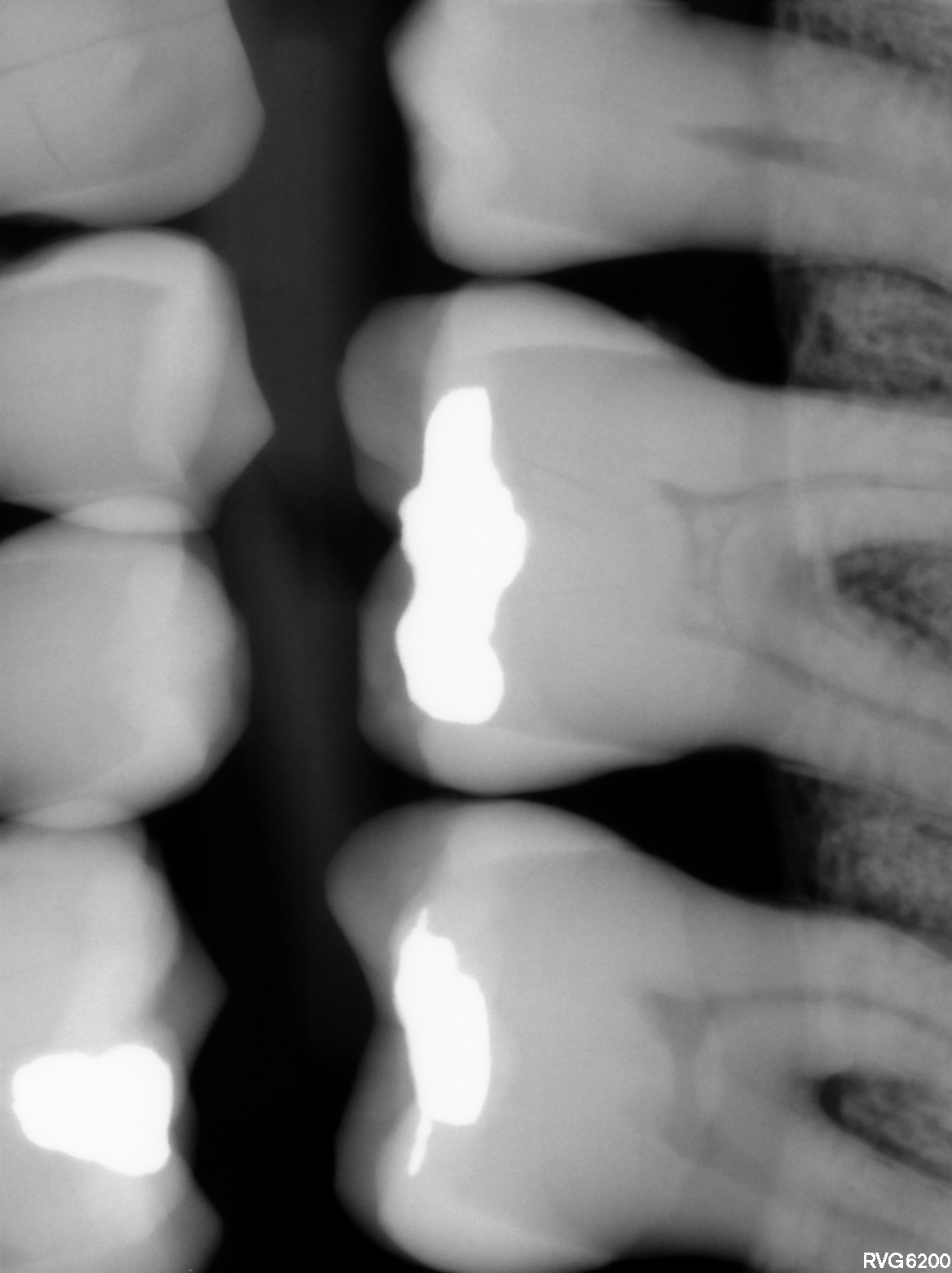 Refurbished Grade A Kodak RVG 6200 Size 1 FAJA0152 - Image 6