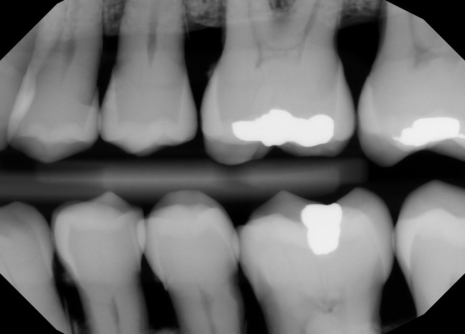 Pre-Owned Dexis IXS size 2 SN: 80071975 - Image 4