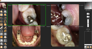 Sodium.Dental.image.Tigerview.intraoral.camera