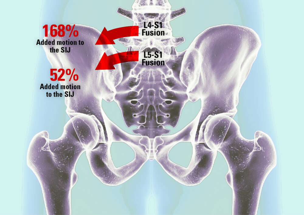 SI Joint Pain Post Deformity Surgery 2023 05 25 220626 bzil