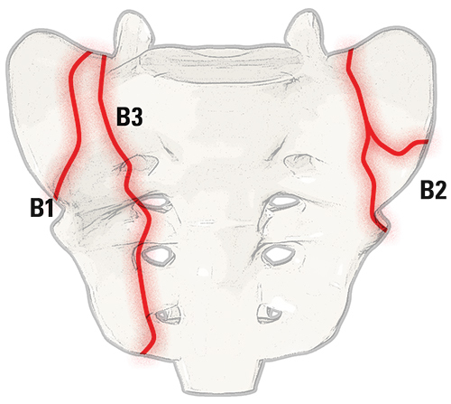 Type B Sacral Fractures