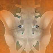 Spinopelvic fixation