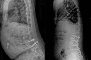 Inline eastlack case 2 03