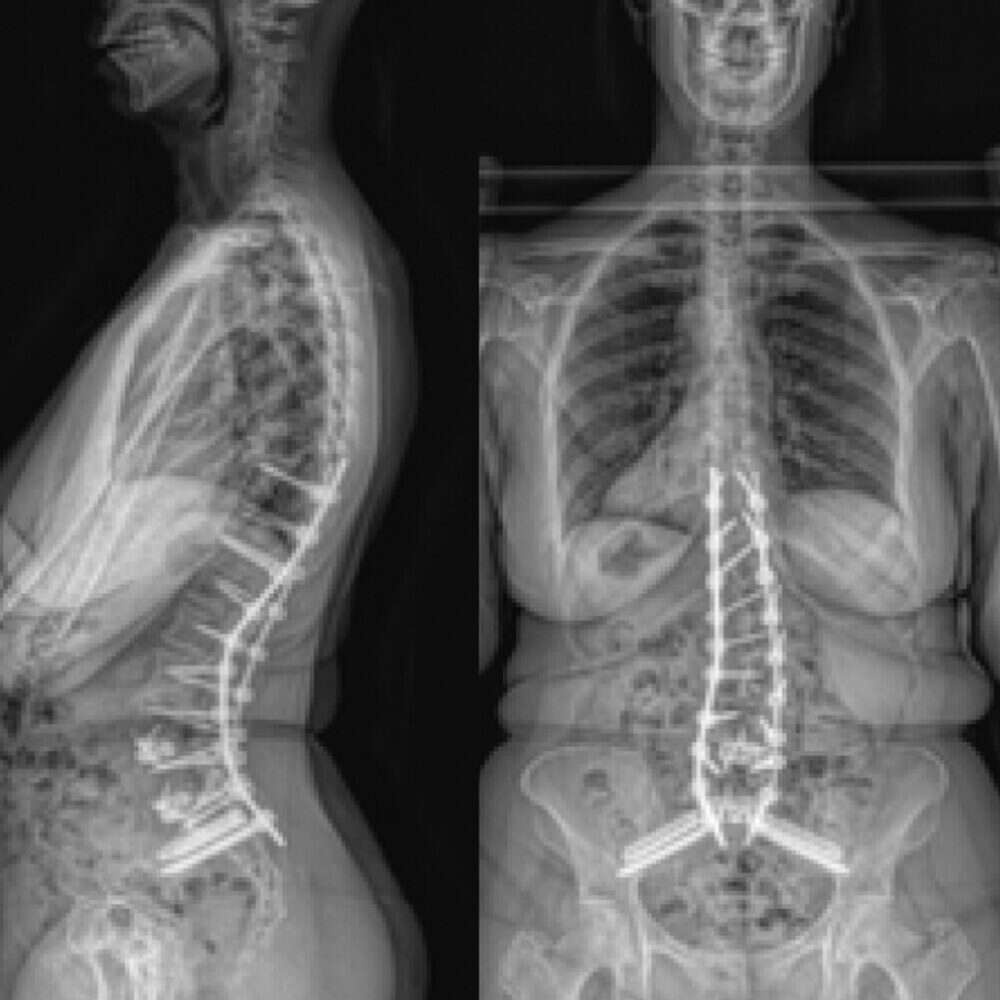 Inline eastlack case 2 02