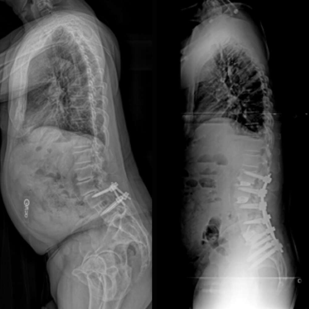 Inline eastlack case 2 03