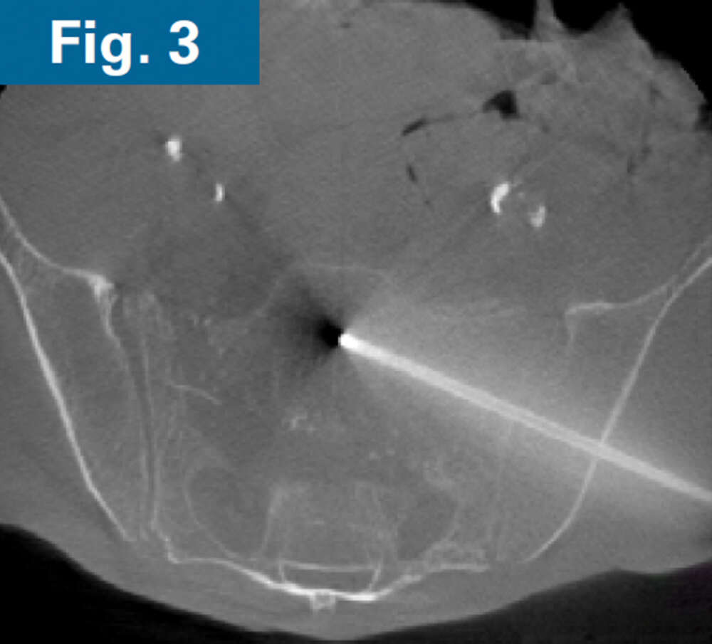 Firoozabadi - spinopelvic dissociation - 3