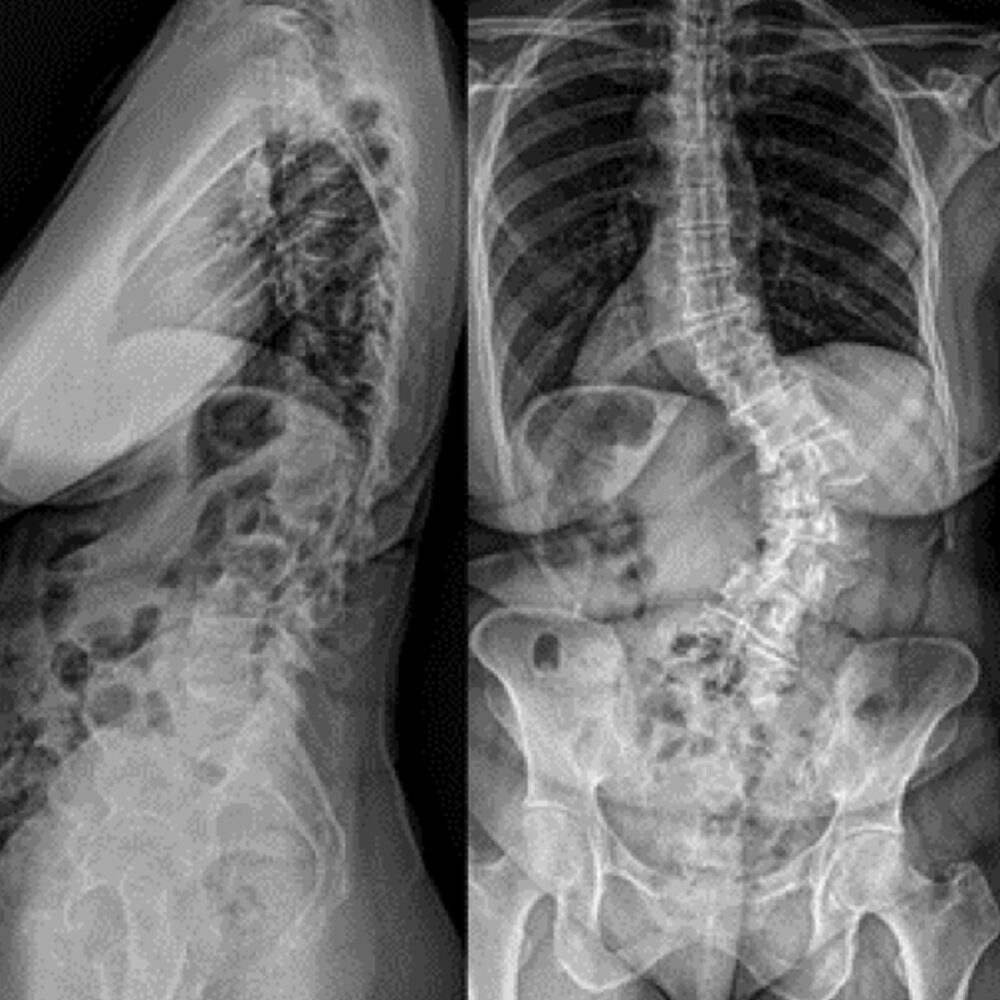 Inline eastlack case 2 01