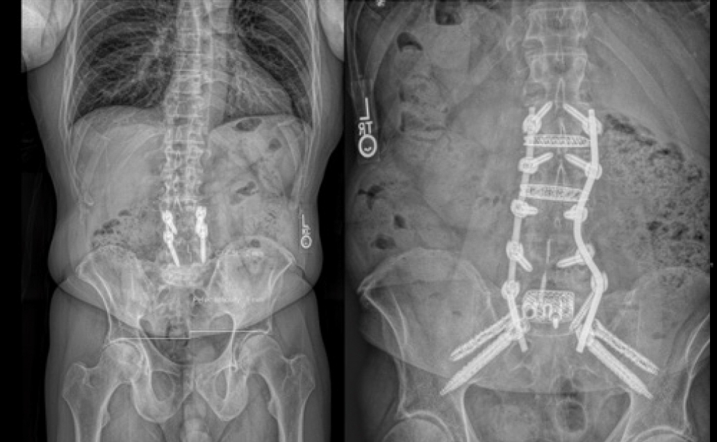 Inline eastlack case 2 04