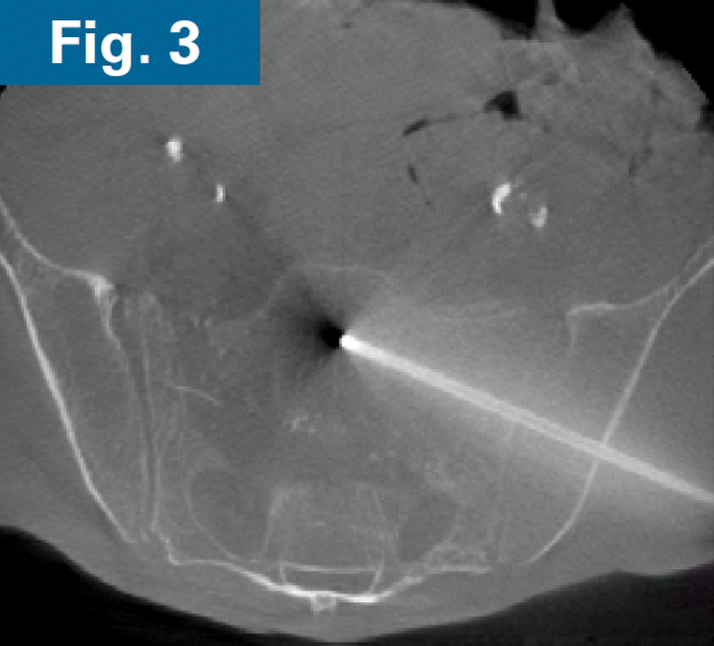 Firoozabadi - spinopelvic dissociation - 3