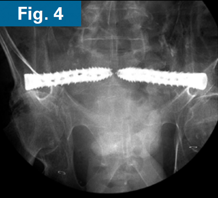 Firoozabadi - spinopelvic dissociation - 4
